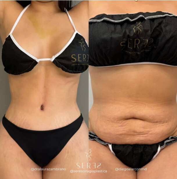 Lipoabdominoplastia - 1