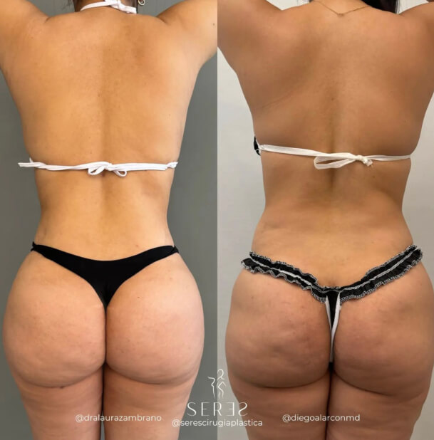 Lipoabdominoplastia - 2
