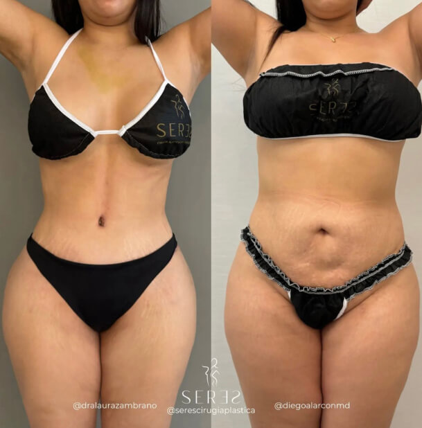 Lipoabdominoplastia - 3