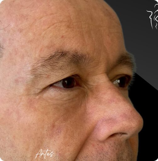blefaroplastia_1_3