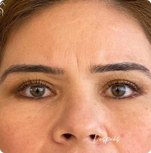 blefaroplastia_1_14