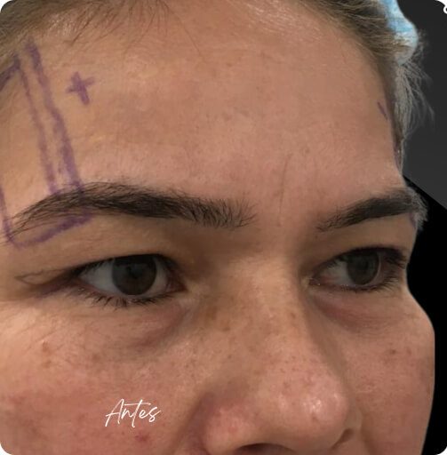 blefaroplastia_1_15