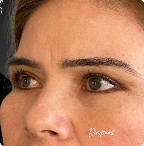 blefaroplastia_1_16