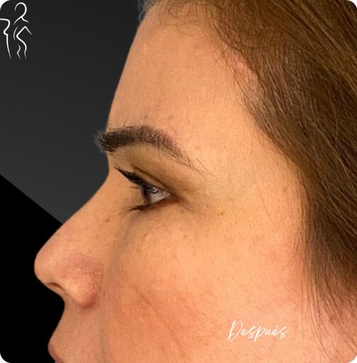 blefaroplastia_1_18