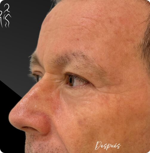 blefaroplastia_1_4