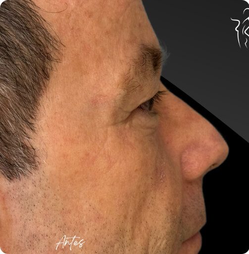 blefaroplastia_1_5