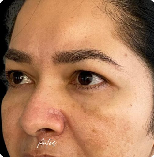 blefaroplastia_1_9