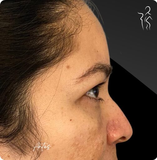 blefaroplastia_1_11