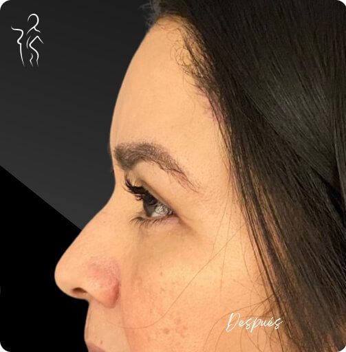 blefaroplastia_1_12