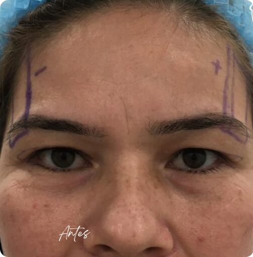 blefaroplastia_1_13