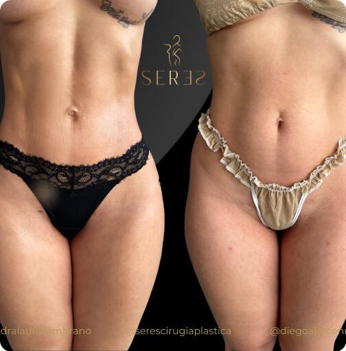 lipogym_1_1