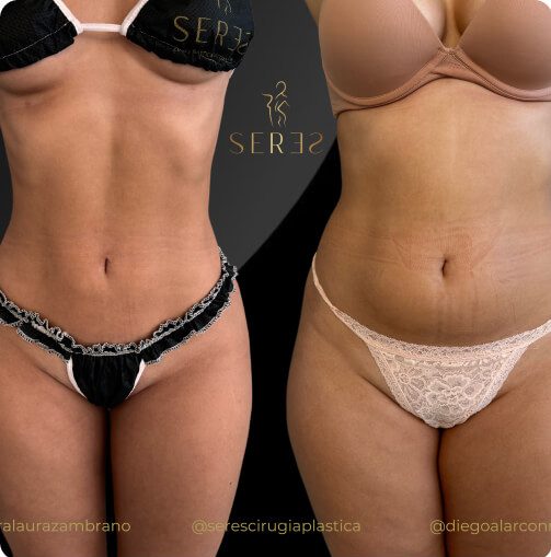 lipogym_1_2
