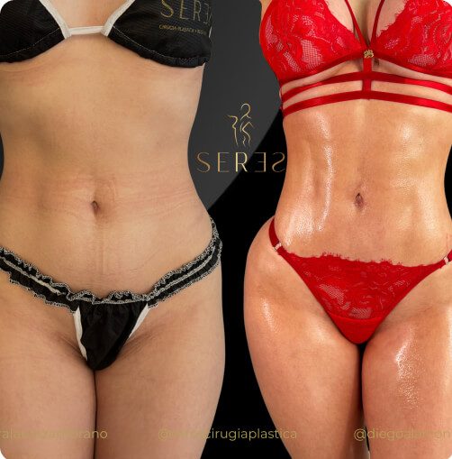 lipogym_1_5