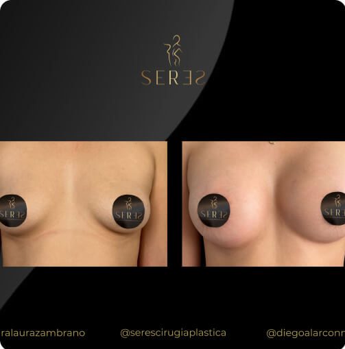 mamoplastia_1_1
