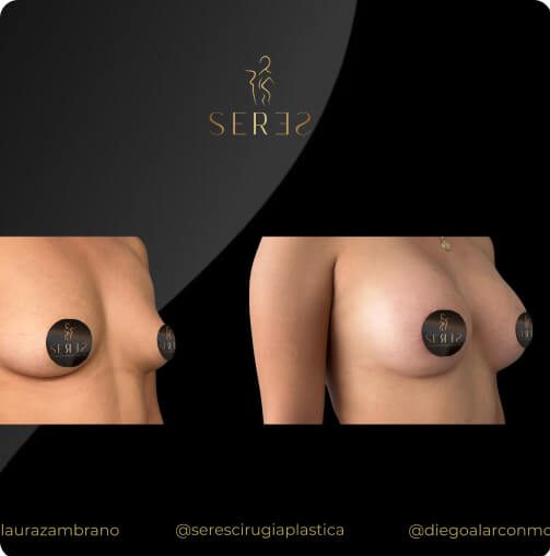 mamoplastia_1_2