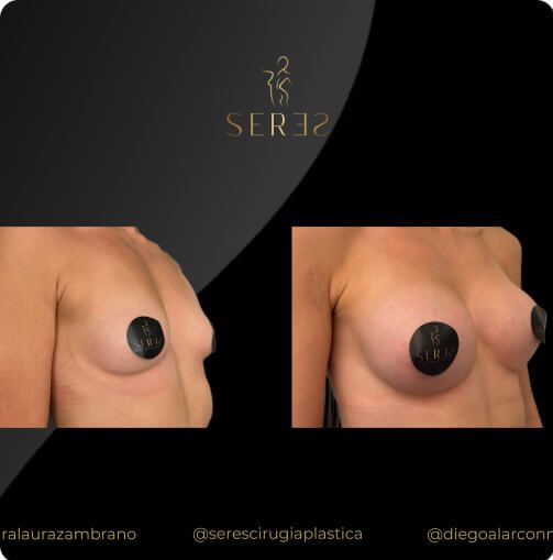 mamoplastia_1_4