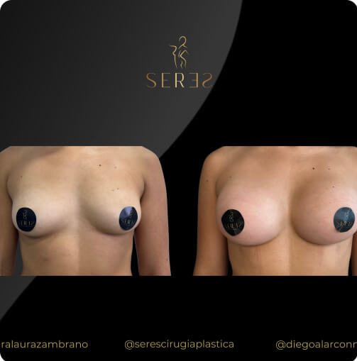 mamoplastia_1_5