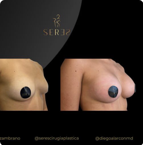 mamoplastia_1_6