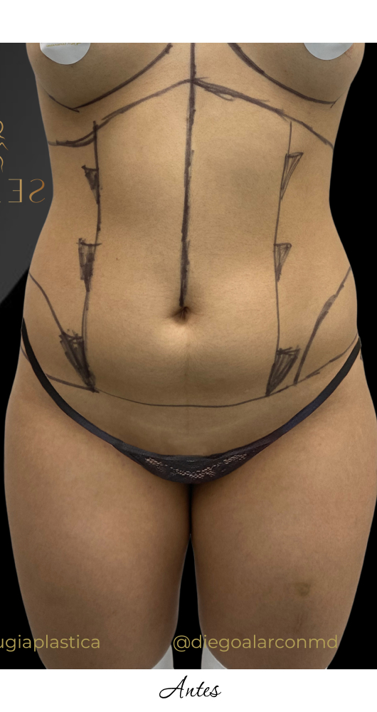 LipoGym_1-1