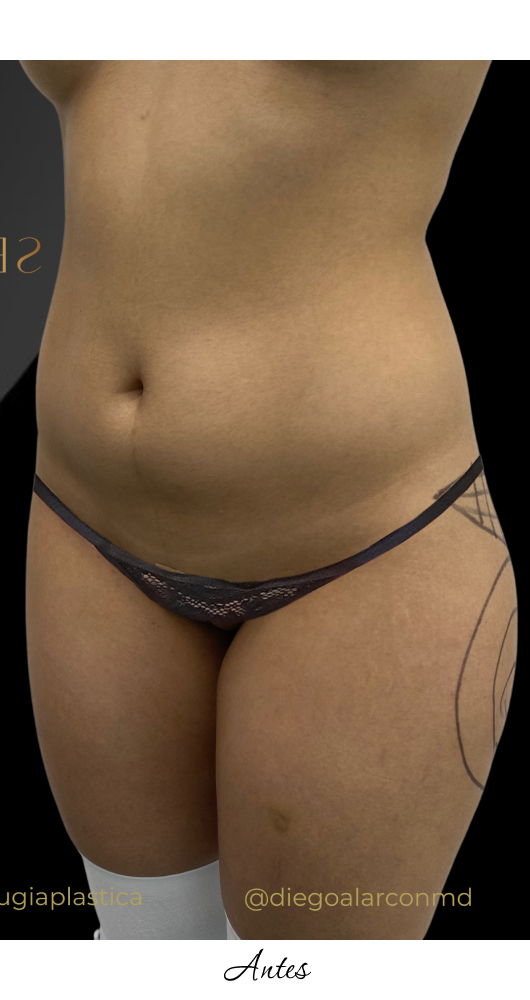LipoGym_1-3