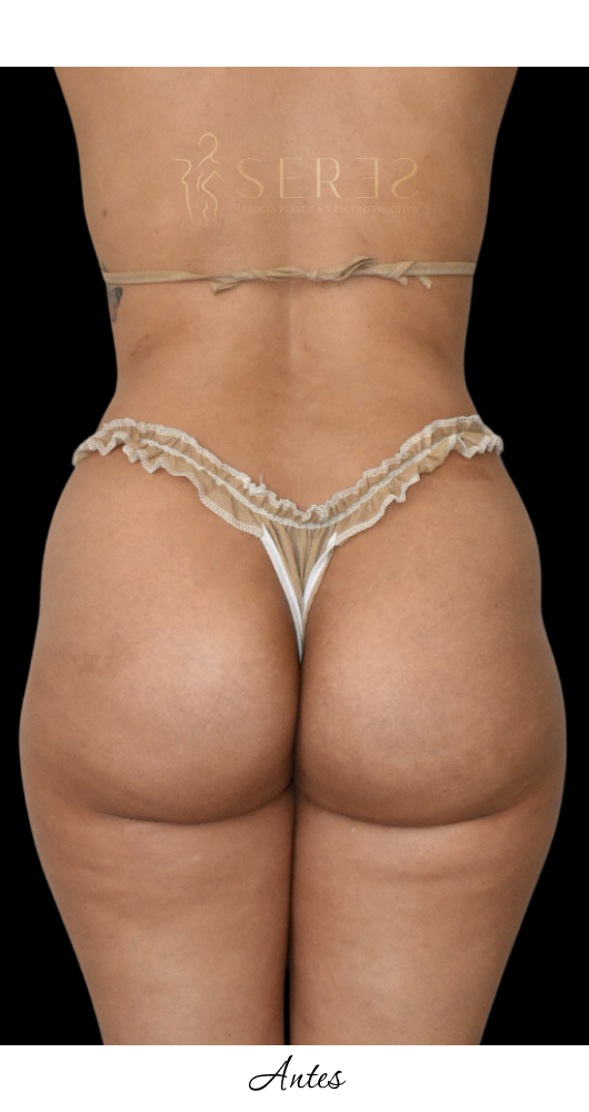 Lipotransferencia Glútea_1-1
