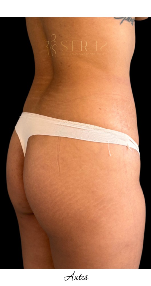 Lipotransferencia Glútea_1-11