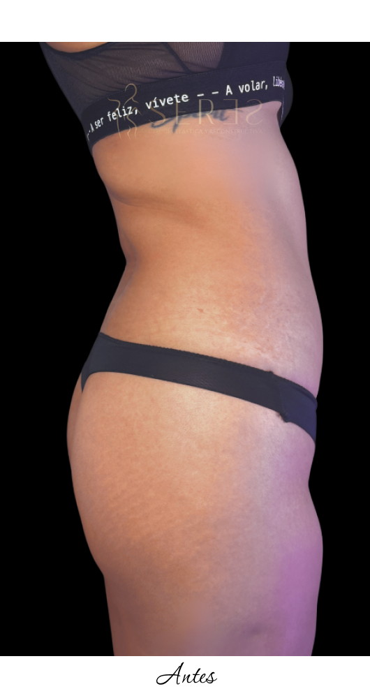 Lipotransferencia Glútea_1-23