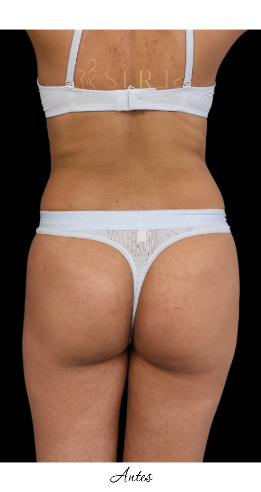 Lipotransferencia Glútea_1-25