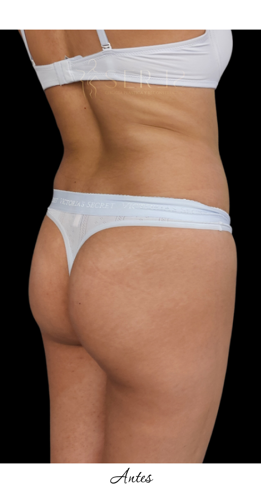 Lipotransferencia Glútea_1-27