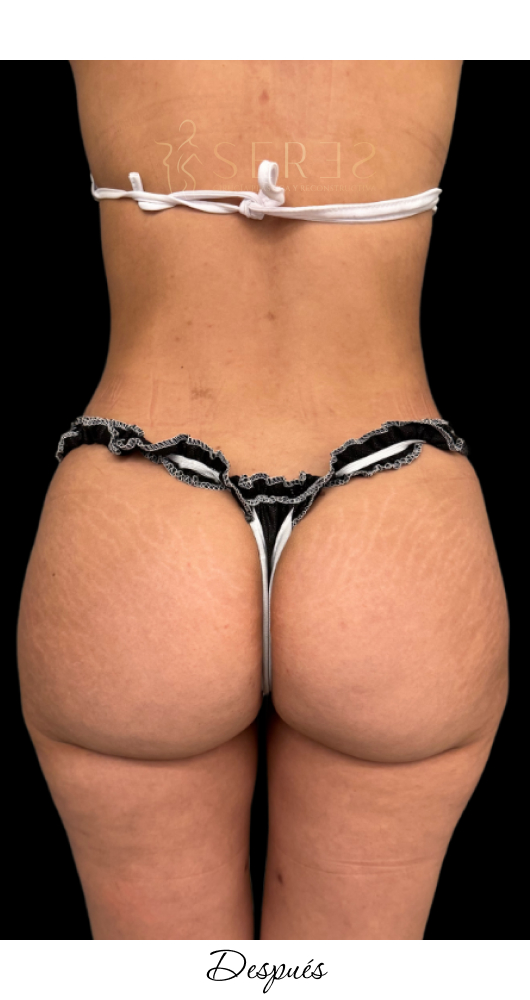 Lipotransferencia Glútea_1-8