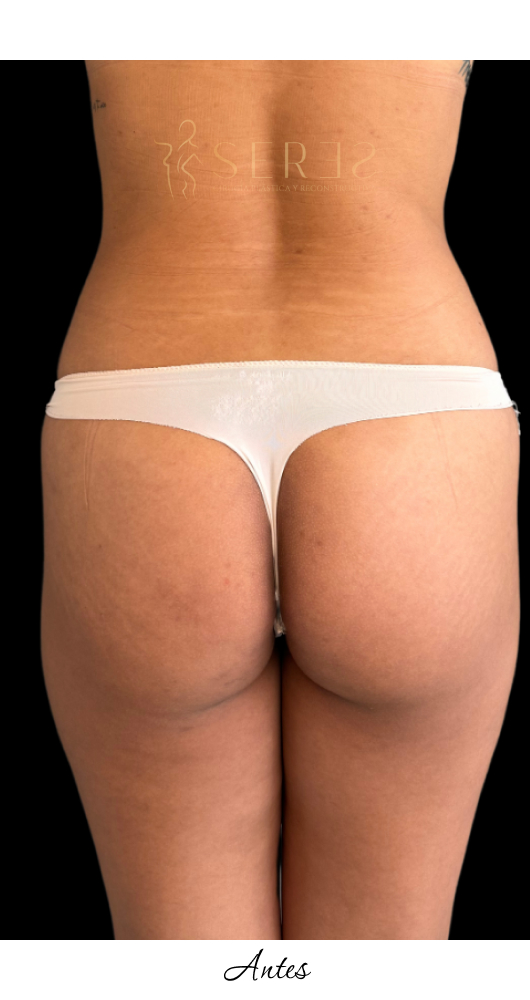 Lipotransferencia Glútea_1-9