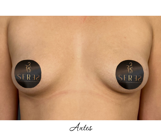 Mamoplastia de Aumento_1-1