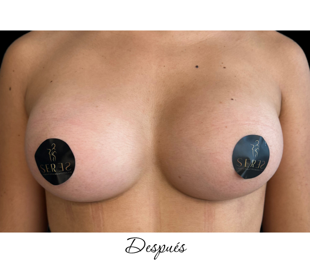Mamoplastia de Aumento_1-10