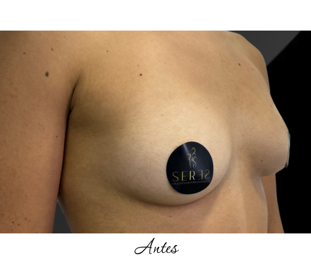 Mamoplastia de Aumento_1-11