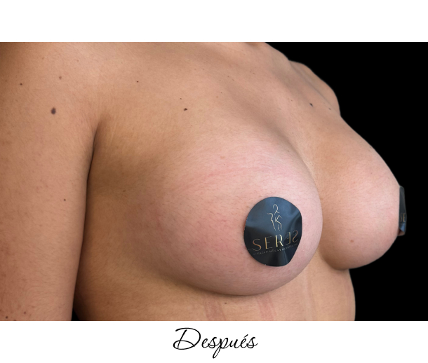 Mamoplastia de Aumento_1-12