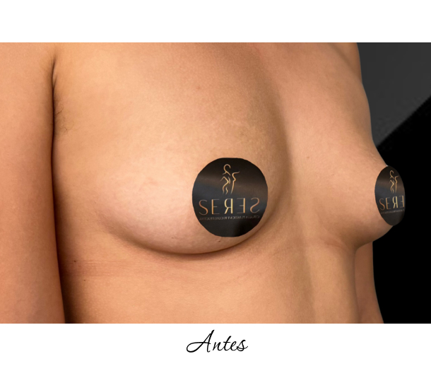 Mamoplastia de Aumento_1-3
