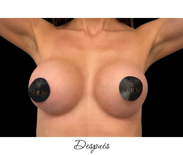 Mamoplastia de Aumento_1-6