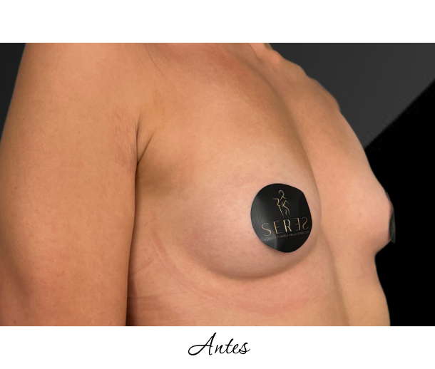 Mamoplastia de Aumento_1-7