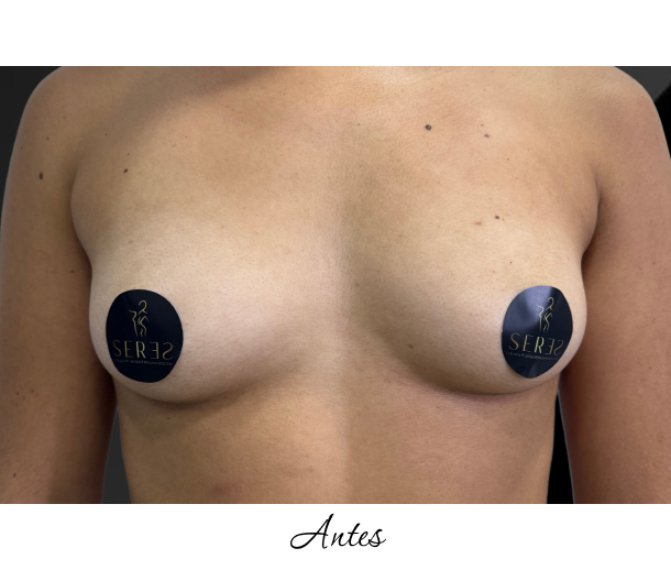 Mamoplastia de Aumento_1-9