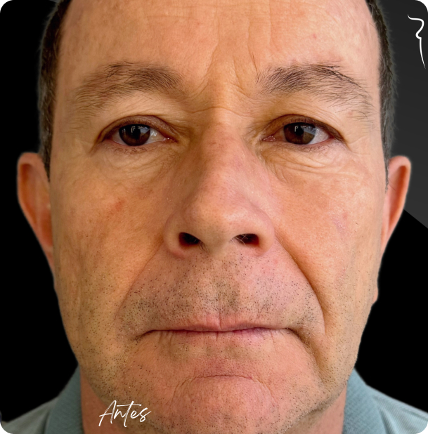 blefaroplastia_1_1