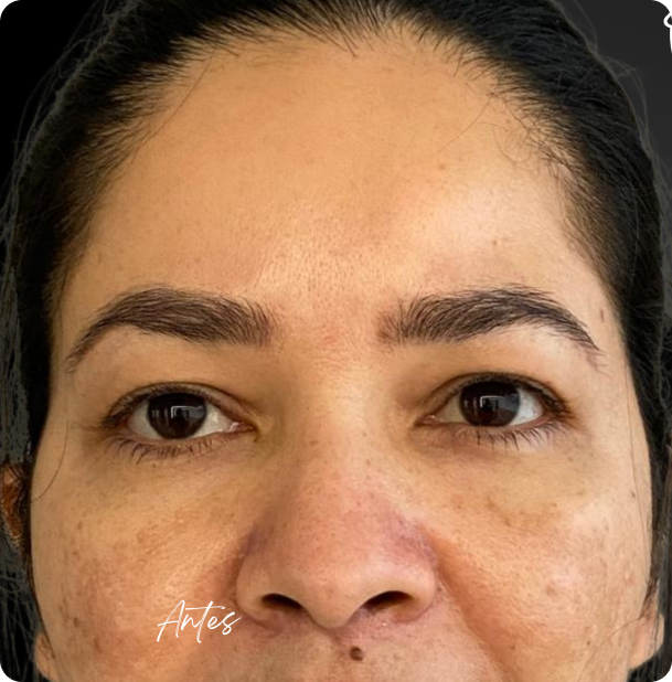 blefaroplastia_1_7
