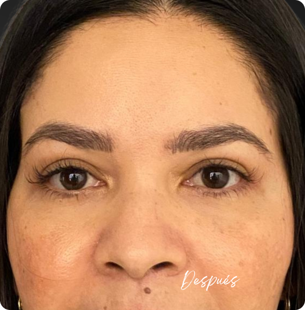 blefaroplastia_1_8