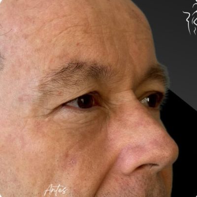 blefaroplastia_1_3