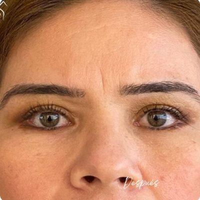 blefaroplastia_1_14