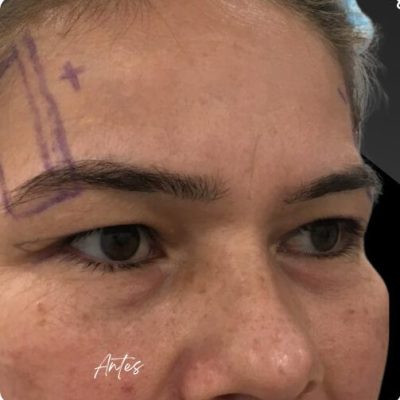 blefaroplastia_1_15