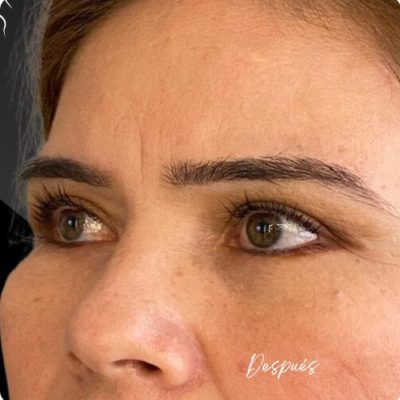blefaroplastia_1_16