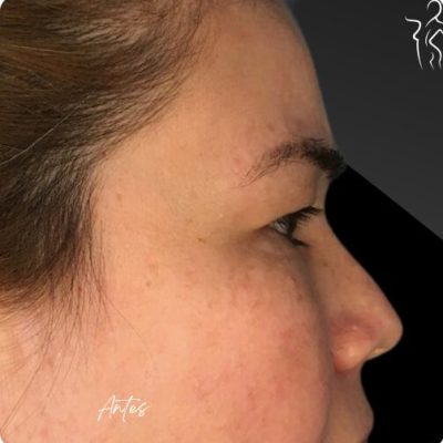blefaroplastia_1_17