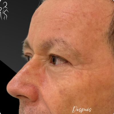 blefaroplastia_1_4