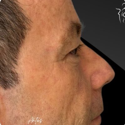 blefaroplastia_1_5
