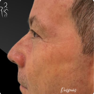 blefaroplastia_1_6